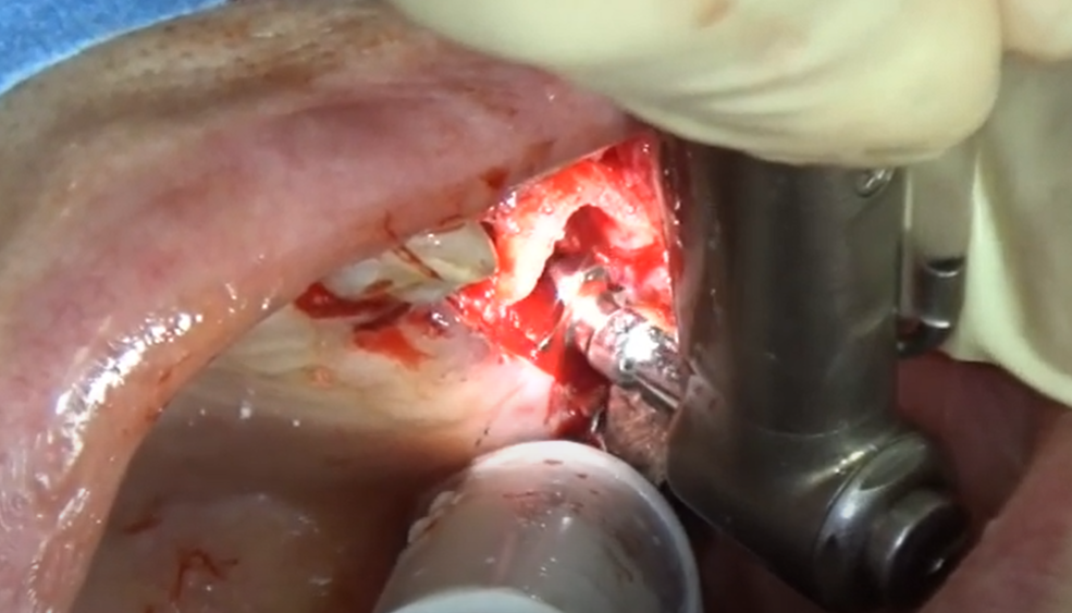 臼歯部のインプラント埋入骨補填
