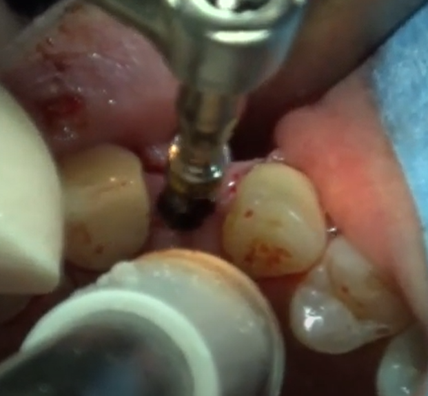 前歯のインプラント植え込み